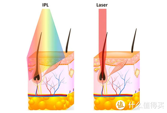 IPL和激光作用在毛囊上的区别