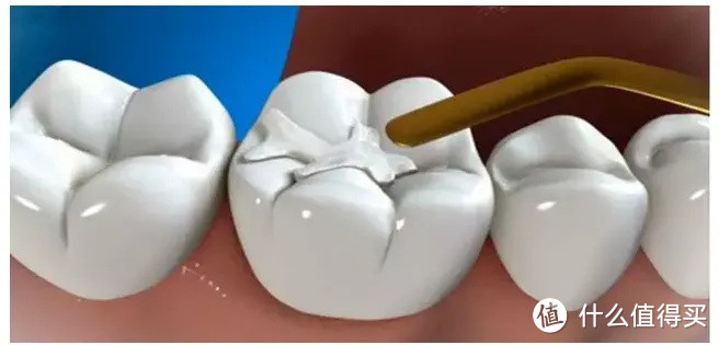 糟糕OMG牙齿怎么敏感啦？？？【预防牙齿敏感手册-建议收藏】