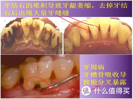（牙菌斑是牙周病的始动因子）