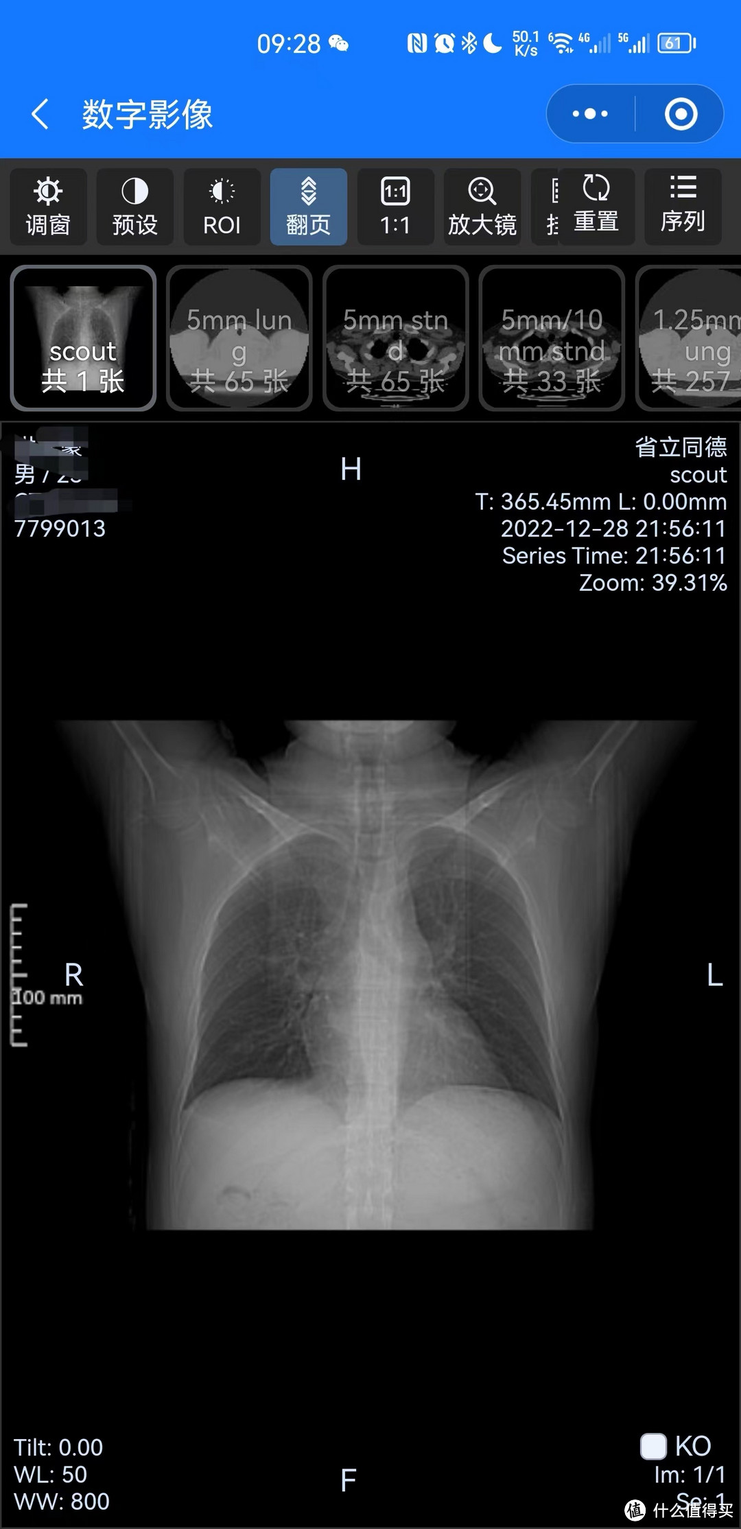 原本以为只是感染中比较轻的症状，没想到一查结果是肺炎！阳后这些这些症状一定不要忽视！