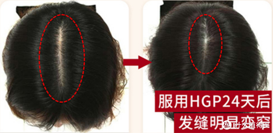 这款HGP生发素简直sha疯了,一个月左右头发就像密林一样的长!!