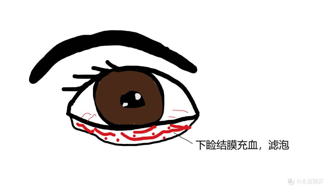 灵魂画图教教你怎么判断儿童过敏性结膜炎