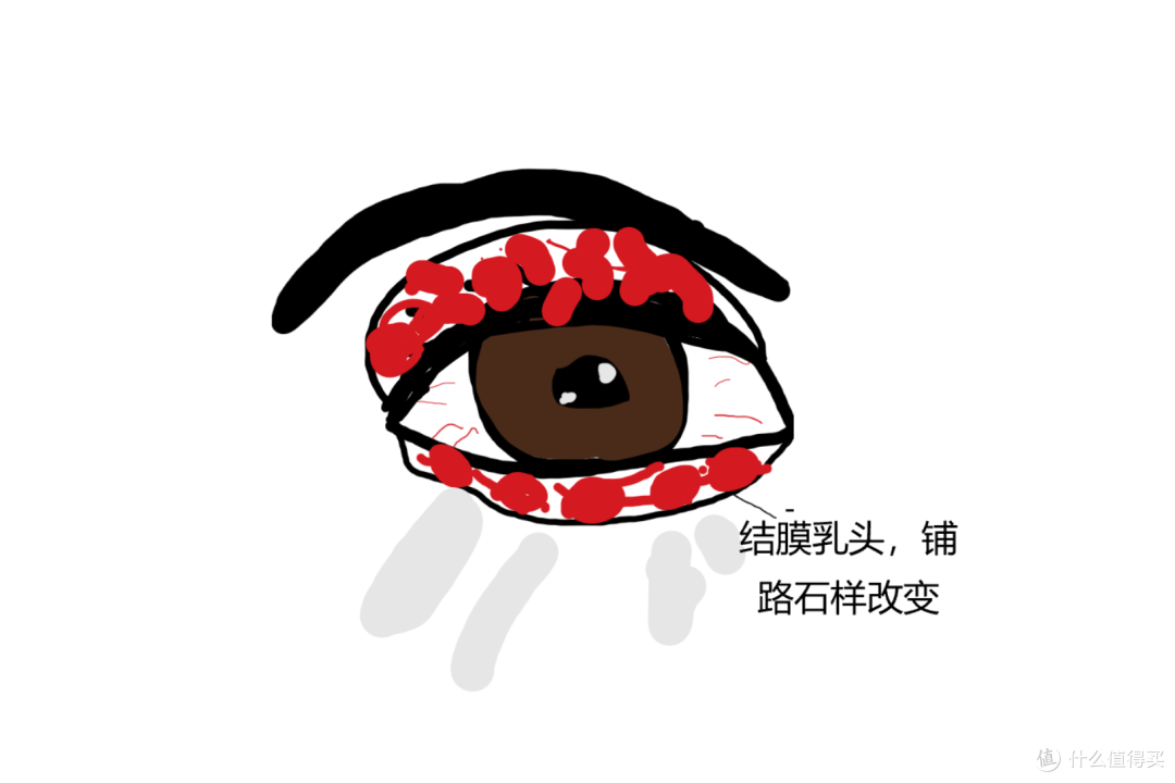 灵魂画图教教你怎么判断儿童过敏性结膜炎