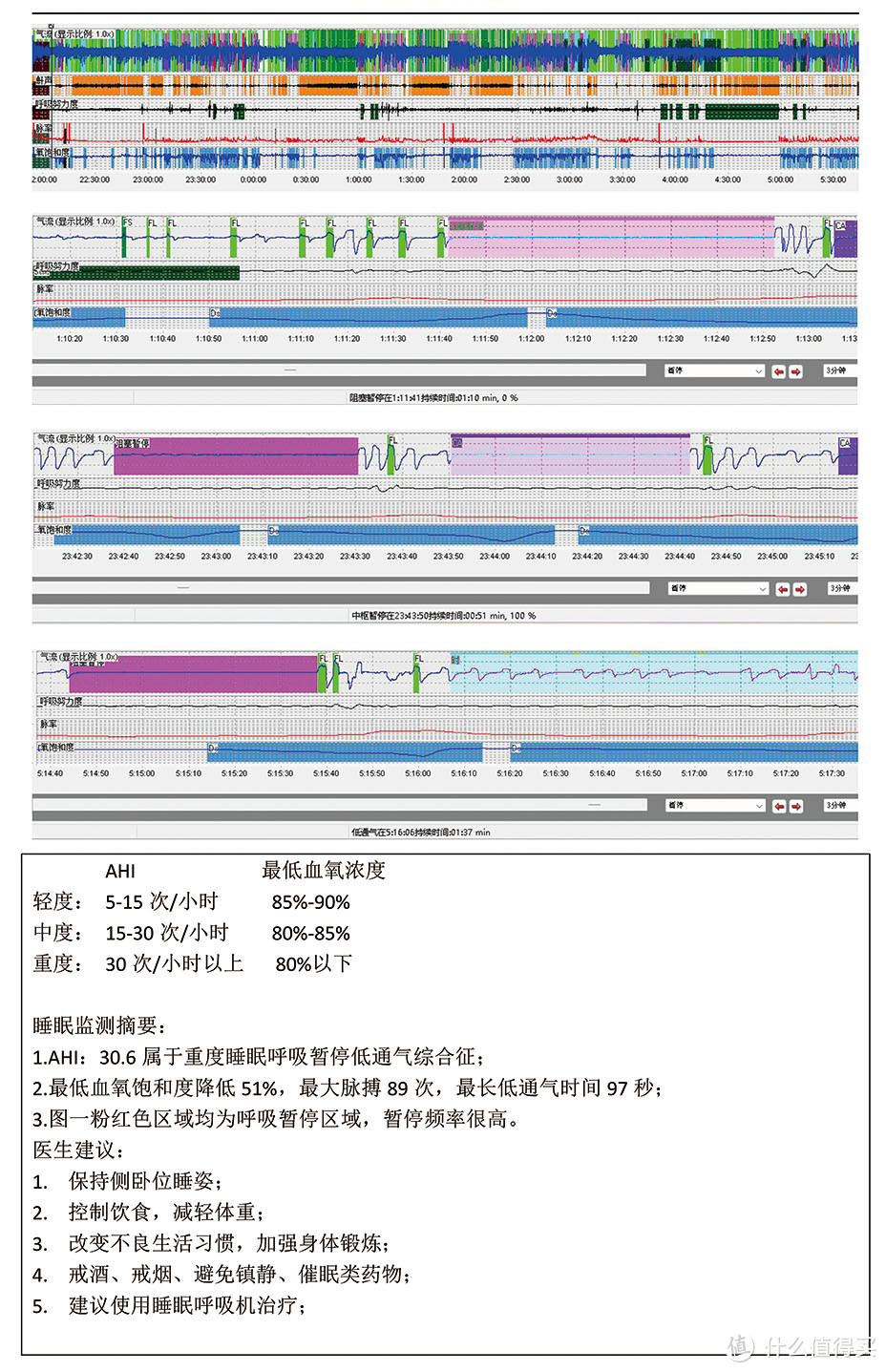 这个618，我捡回了半条命：OSAHS和呼吸机的使用感受