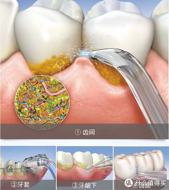 冲牙器：比牙刷更好的口腔清洁工具？