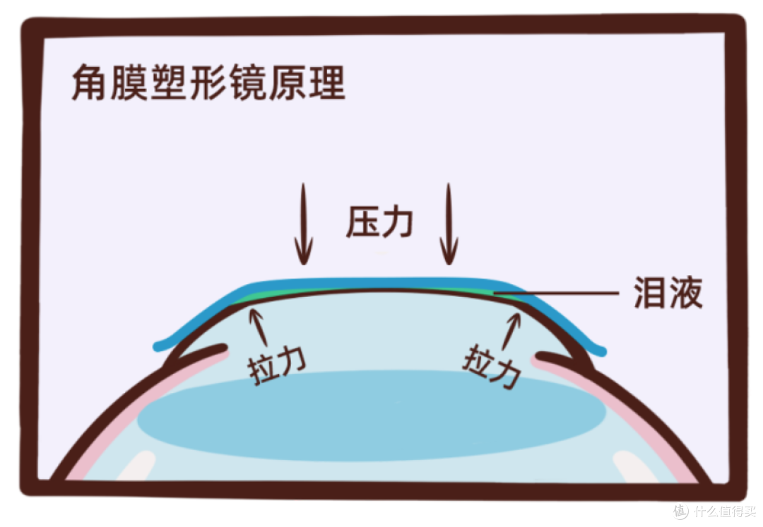 聊一聊角膜塑形镜对儿童近视的帮助