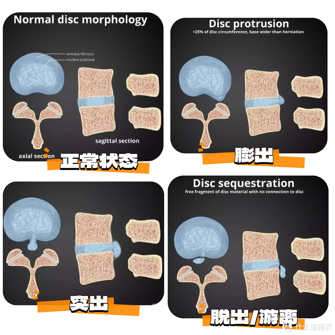 腰疼？腰疼的分类以及预防大于治疗的锻炼方法，嘿，跟着运动康复老师学一下，别只是小燕飞啦～