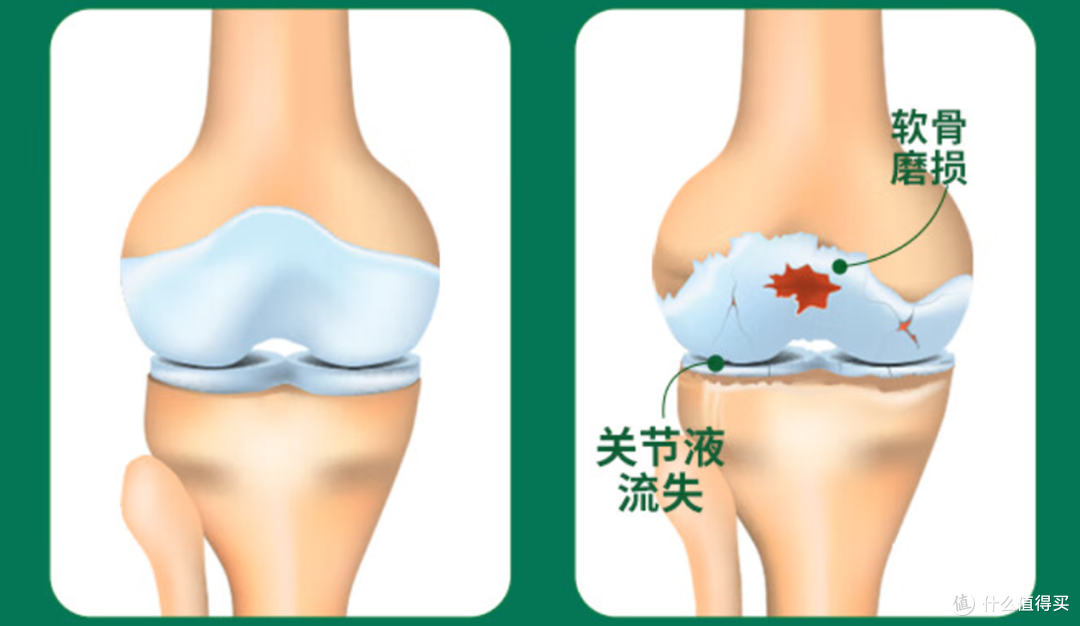 关节问题年轻化?做好防护无需愁!Move Free保健品选购攻略