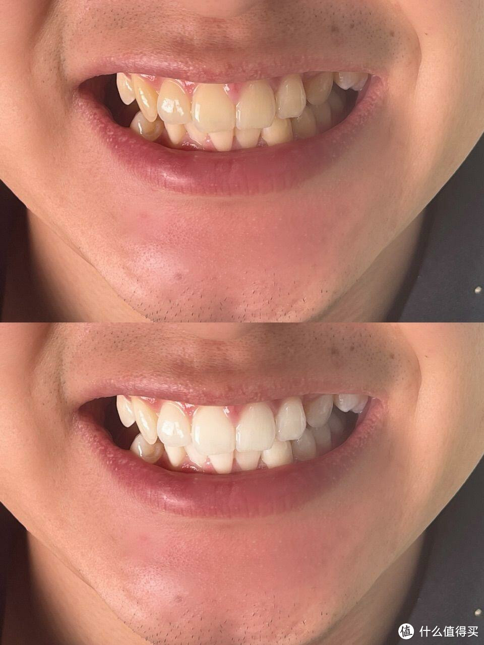 可菲可丽洁白冲牙器体验报告：清洁护齿＆美白牙齿，让我笑容更自信