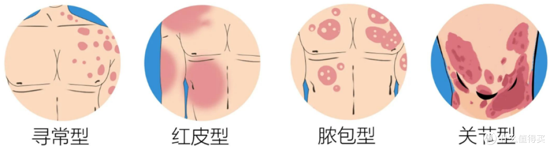 银屑病能彻底治疗吗?