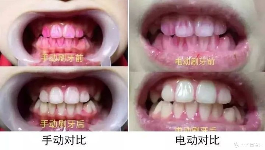 牙齿敏感可以用电动牙刷吗?离开三大坏处骗局!