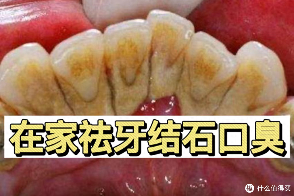 重度牙结石口臭都来试试！能帮一个是一个！省钱靠谱！