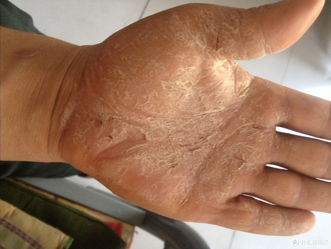 手足皲裂不要怕!高性价比治疗方法大揭秘,皮肤瞬间光滑娇嫩!