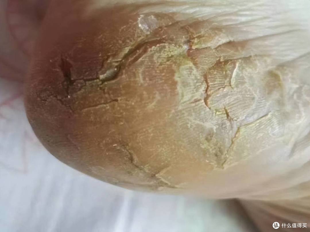 手足皲裂不要怕!高性价比治疗方法大揭秘,皮肤瞬间光滑娇嫩!