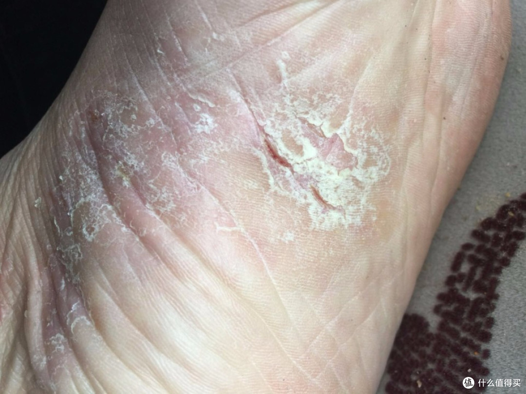手足皲裂不要怕!高性价比治疗方法大揭秘,皮肤瞬间光滑娇嫩!