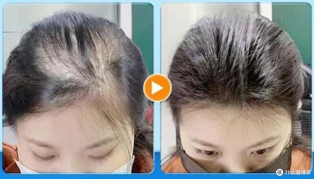 学生脱发可以用防脱洗发水吗?长效护理,守护秀发的宝藏!