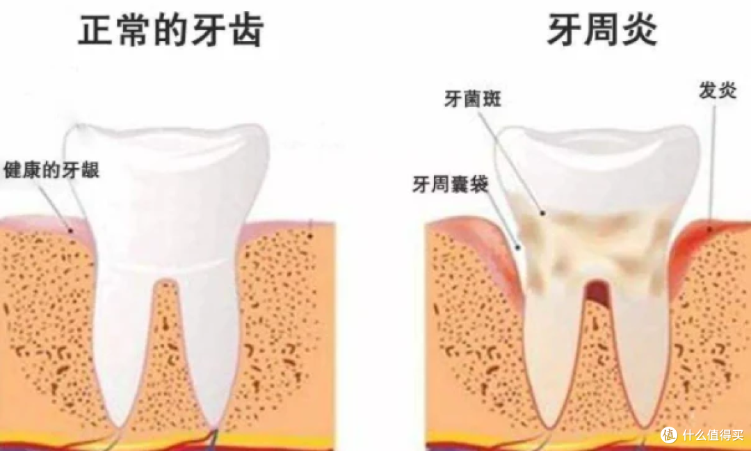 电动牙刷会伤害牙齿吗？详解三大深坑风险，提高警惕！