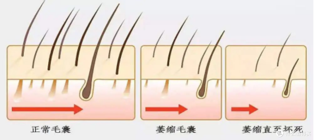 【脱发必看】2023高效防脱攻略!医学硕士教你4招,3个月改善头顶稀疏、养出浓密发量!