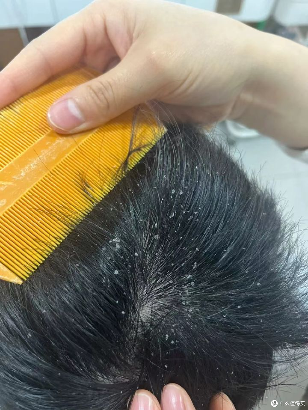 男生头皮屑好多,挠了又很痒怎么办?30天仅需3步走,头屑头皮瘙痒烦恼不再反复......
