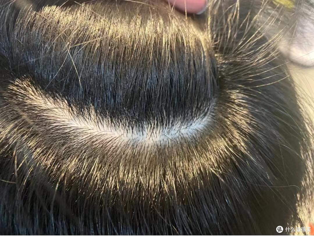 男生头皮屑好多,挠了又很痒怎么办?30天仅需3步走,头屑头皮瘙痒烦恼不再反复......