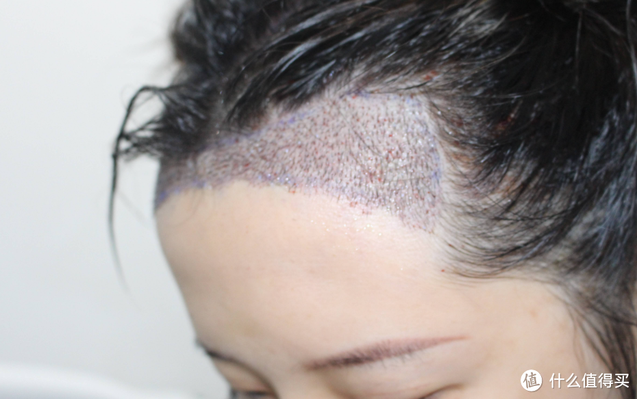 脂溢性脱发如何让头发发质变好？盘点15大护理技巧！