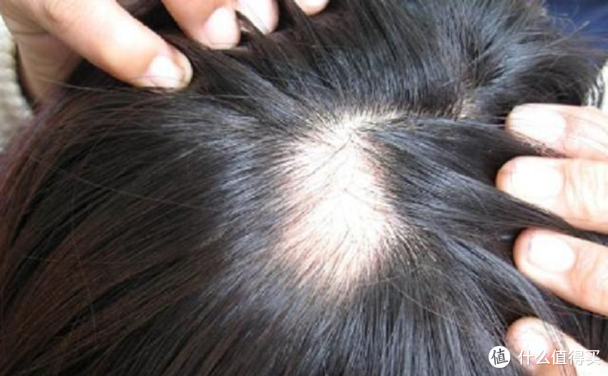 脂溢性脱发如何让头发发质变好？盘点15大护理技巧！
