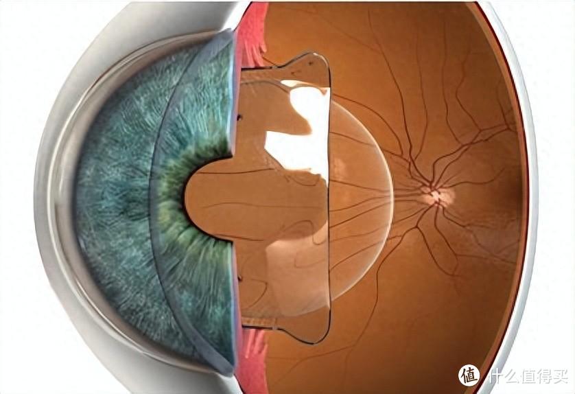 不能做激光类近视手术，角膜薄又是高度近视怎么办？