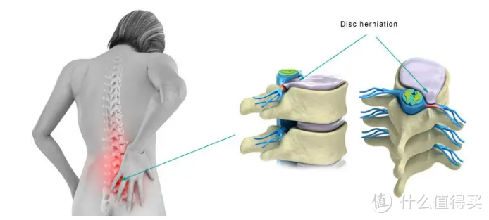 腰间盘突出14大护理指南分享，快收藏！ 