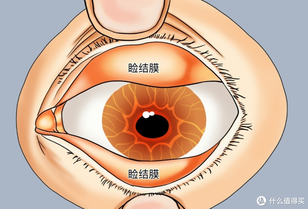 眼睛干痒怎么办？是不是患上了沙眼？滴眼药水能解决大多数问题！