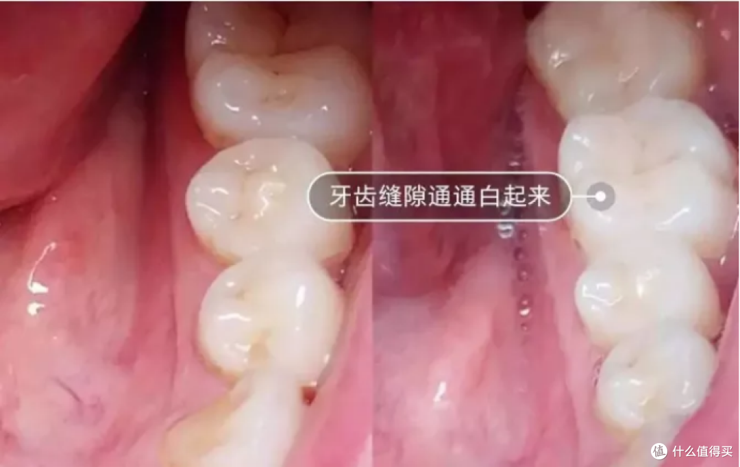 电动牙刷对牙齿有伤害吗?起底三大副作用潜规则!