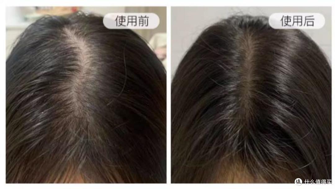 用什么洗头可以防止脱发?头皮康复师,重塑秀发的活力!