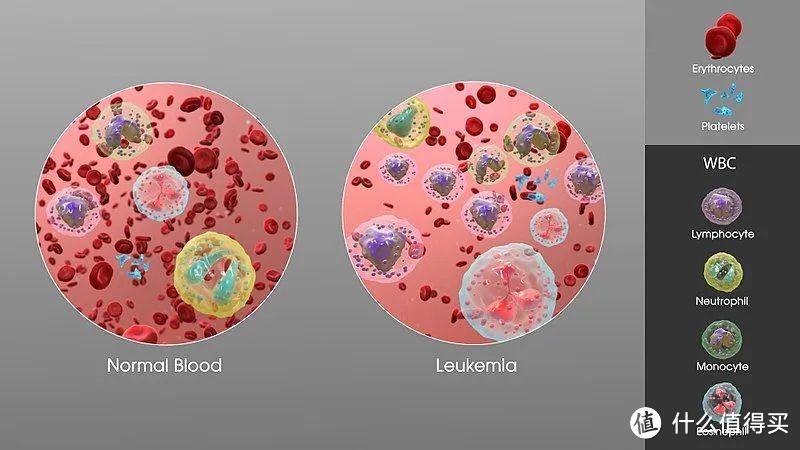 较正常人体血液（左），白血病患者体内白细胞增多（右）图片来源：wikipedia