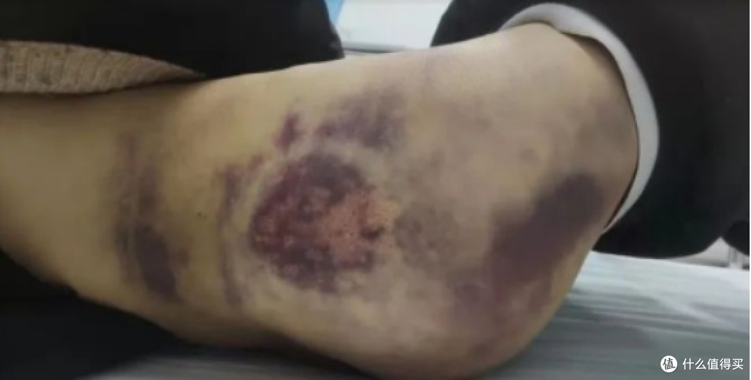 为什么医生不推荐使用筋膜枪?三大危害弊病千万注意!