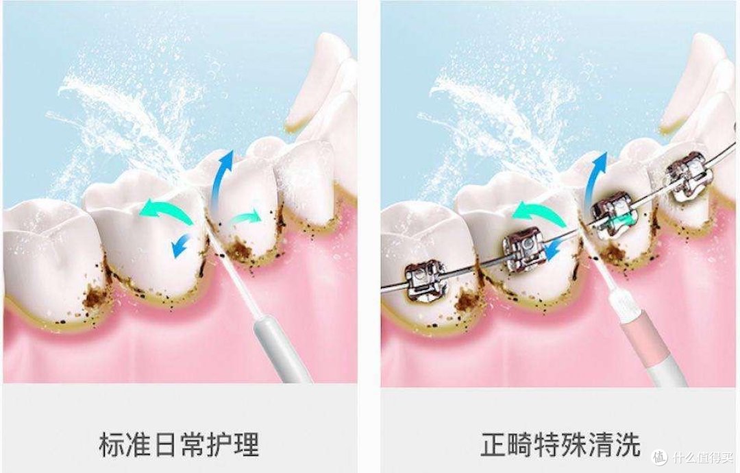 牙医是否推荐使用冲牙器?防备四大雷区风险!