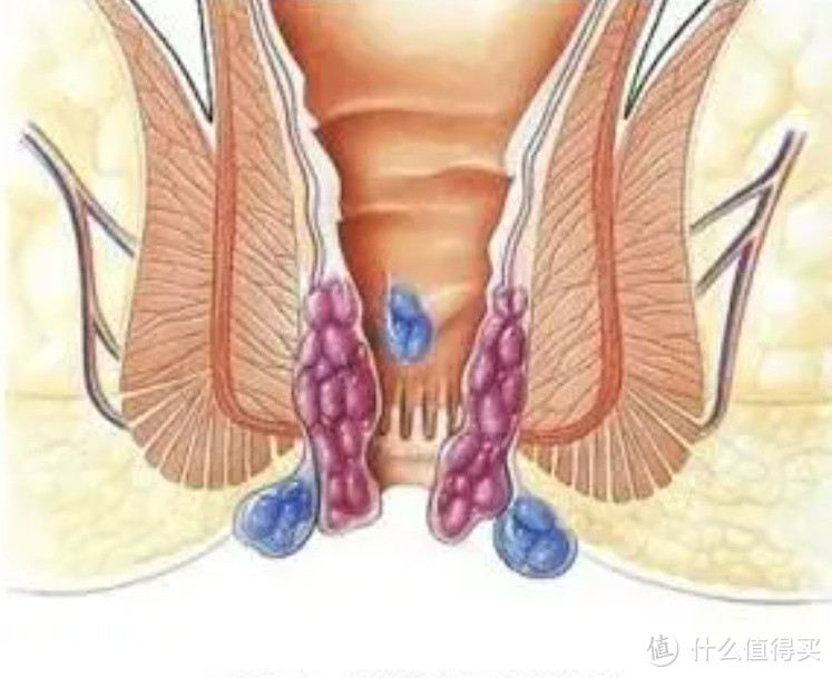 中年男士的人生第一刀：混合痔+肛瘘