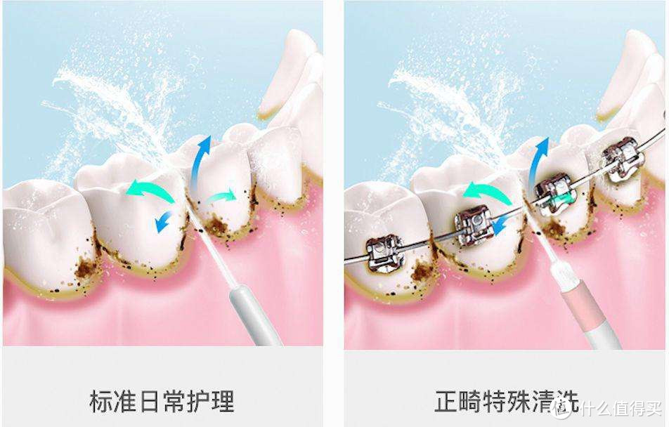 正畸牙齿矫正能用冲牙器吗？避雷三大缺陷症结！