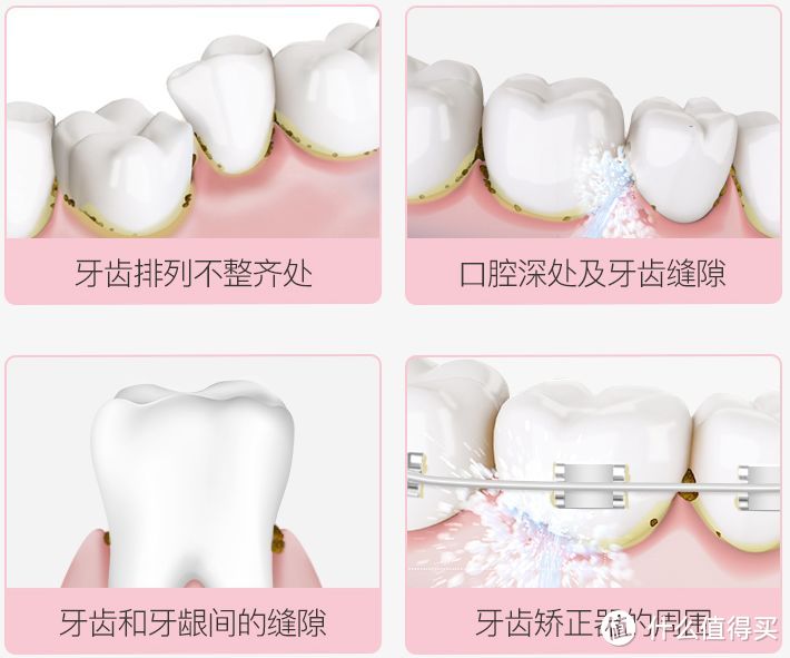 牙周炎能用冲牙器吗?警告四大圈套危害!