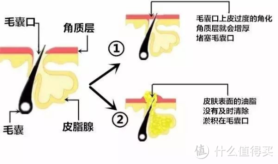 跟痘痘说拜拜！祛痘秘籍大公开