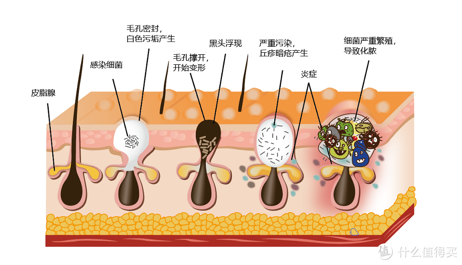 科学护理痘痘肌，告别“痘”争岁月！