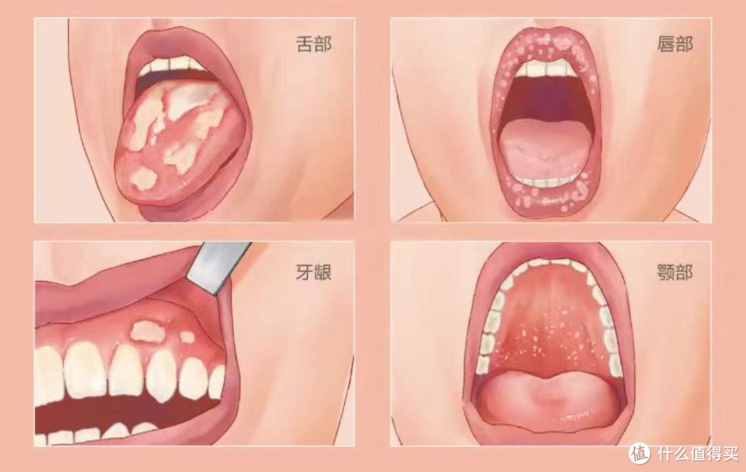 无语，口腔扁平苔藓怎么是这个样子，为啥长这里？