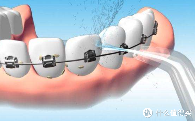 戴牙套可以用冲牙器吗？严防三大缺点弊端！