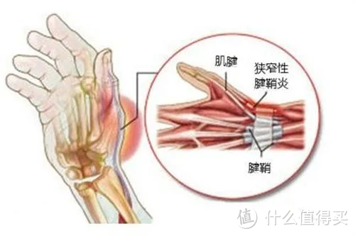 你的手腕还好吗？手腕腱鞘炎是什么？如何预防与纠正？讲解护腕真正的用处，康复师都推荐的护腕有这些！