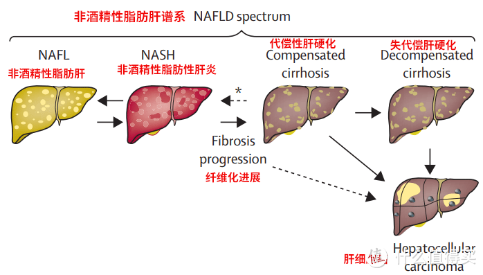 “脂肪肝”离“肝癌”有多远？仅有“四步”！