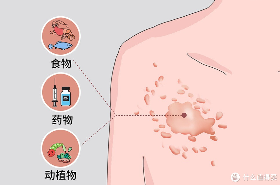 抗荨麻疹老油条今天来聊聊过敏那些事