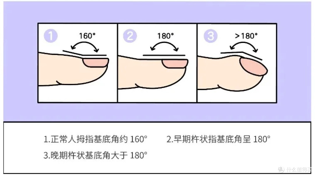手指出现这个变化,小心是身体发出的危险信号!