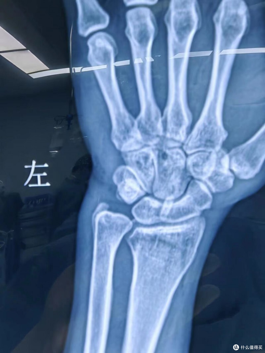 衢州骨伤科医院完成首台腕关节镜手术,微创小切口解决多年手腕疼痛
