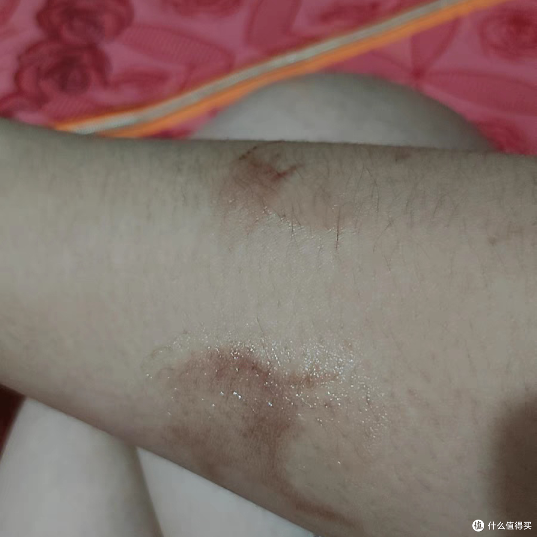 去他的烫伤,只要有它在,我啥都不怕!