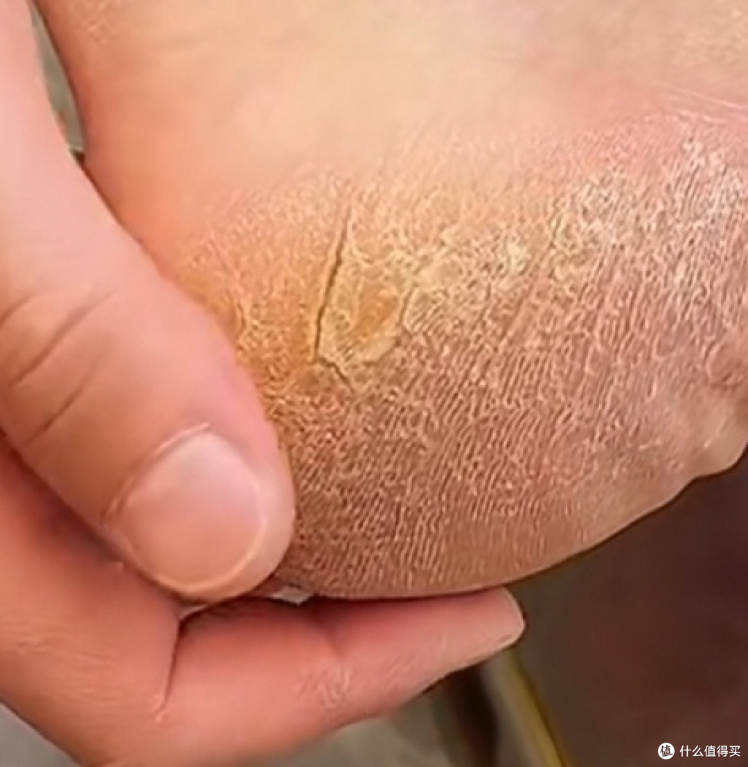 天啊！脚后跟开裂竟然可以这样解决！