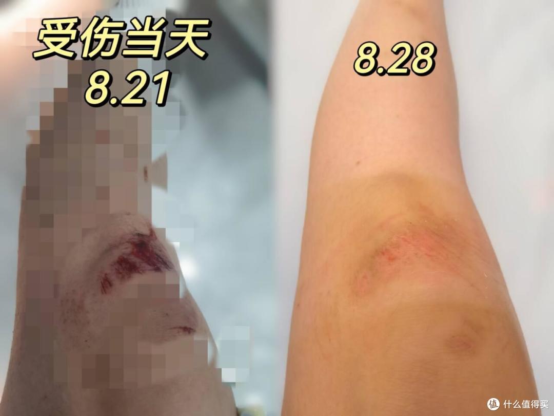 擦伤膝盖胳膊腿怎么护理才能不留疤摔伤后护理全过程实录跟我这样做真