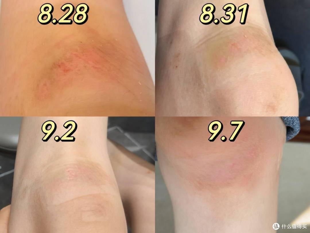 擦伤膝盖胳膊腿，怎么护理才能不留疤？摔伤后护理全过程实录，跟我这样做真的不留疤！！